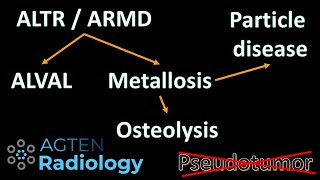 Hip Metallosis Pseudotumor ALVAL or ALTR or ARMD [upl. by Ettecul]