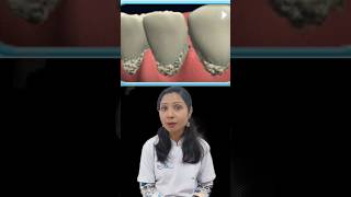 Dental Tip1 दांत साफ करने का तरीका Plaque Removal From Teeth trending dentistdoctor shortfeed [upl. by Eileen]