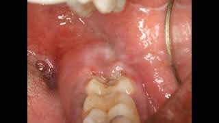 Operculectomy procedure with blade Painful swollen gum around wisdom tooth Pericoronitis Treatment [upl. by Ahsitnauq348]