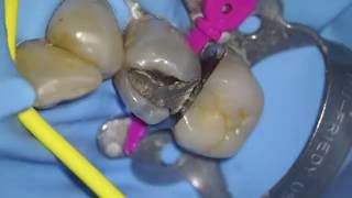 28 amalgam removal direct vision at Towson Dentist [upl. by Baugh]