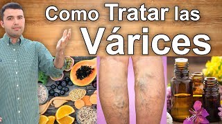 COMO ELIMINAR LAS VARICES PARA SIEMPRE  Tratamientos Naturales Para las Várices en las Piernas [upl. by Bihas453]