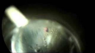 Laser Peripheral Iriditotomy to Prevent Glaucoma Part 2 [upl. by Ydaf]