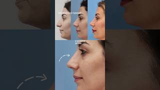 Swelling after rhinoplasty is real It takes time for the final shape of the nose to reveal itself [upl. by Cleve]