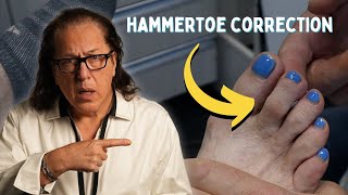 Hammertoe Correction Without Invasive Surgery [upl. by Thury575]