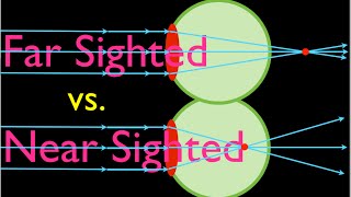 Farsighteness vs Nearsightedness An Explanation [upl. by Simeon45]