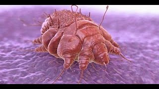 ☢☢Where Do Scabies Come From How To Kill Scabies Mites On Bedding Get Rid Of Scabies [upl. by Eldrid]