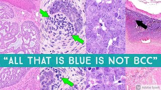 quotAll that is Blue is Not Basal Cell Carcinomaquot  BCC vs Mimics  Dermpath Dermatology Pathology [upl. by Elvina301]