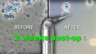 Spirochetes Killed 2 Week Post Op Part 2 of 3 [upl. by Namad]