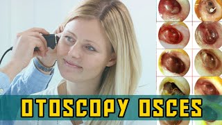 OTOSCOPY OSCEs  PLAB Image Reference [upl. by Peregrine642]