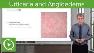 Urticaria Hives and Angioedema – Pediatrics  Lecturio [upl. by Lazare233]