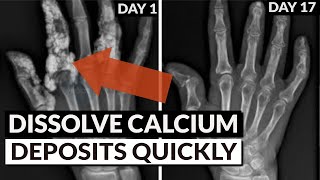 Reverse Soft Tissue Calcification Bring Calcium Out Of Tissue amp Into Bones [upl. by Nibor344]