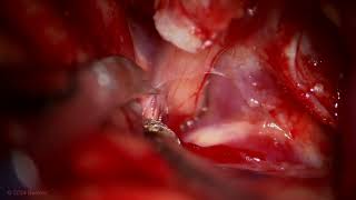 Pterional Craniotomy with Intradural Anterior Clinoidectomy for Clipping of an OphA Aneurysm [upl. by Lezti831]