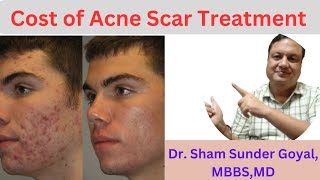 Cost Of Acne Scar Treatment  Cost of Combination Treatment  Acne Scar [upl. by Bonneau]