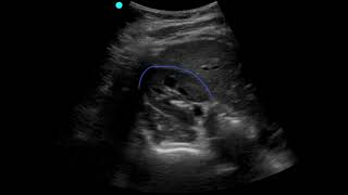 POCUS  Soft Tissue  Lymphadenopathy [upl. by Burroughs821]