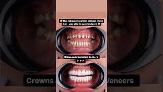 Porcelain veneers and Crowns by Dr AndresGarcia  CALI COLOMBIA 🇨🇴 nyc [upl. by Asennav]