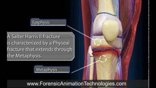 Tibia Fracture Salter Harris II  3D Computer Animation [upl. by Anitnahs]