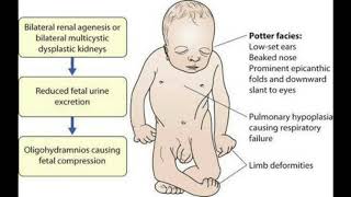 Oligohydramnios and polyhydroaminos 2 [upl. by Bobbie]