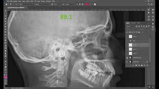 Cephalometrics Part 1 المرحلة الخامسة [upl. by Adina]