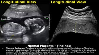 Placenta Ultrasound Reporting  How To Write Pregnancy USG Reports  Pathologies amp Positions Scans [upl. by Isia]