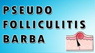 Pseudofolliculitis Barbae Symptoms Treatment and Causes [upl. by Monto]