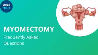 Myomectomy Frequently Asked Questions [upl. by Evelin]