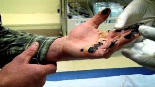 Hand Burnt in Tar  Part 1  Bizarre ER [upl. by Corry832]