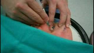 Retrobulbar injection for cataract surgery anesthesia [upl. by Collin]