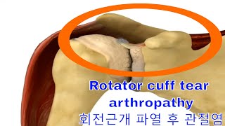 Rotator cuff tear arthropathy [upl. by Anel228]