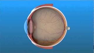 Vitrectomy Surgery for Detached Retina [upl. by Simpson]