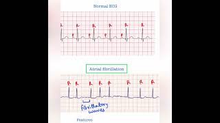 Atrial fibrillation ECG  USMLE Step 1 amp 2 [upl. by Eedahs]