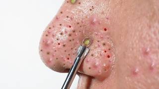 ACNE REMOVAL  Pimple Popping  SATISFYING Blackhead amp Whitehead Extraction [upl. by Atteynod824]