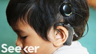 How Do Cochlear Implants Work [upl. by Philpot]