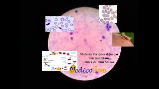 Peripheral Smear  Plasmodium falciparum  Thick and Thin Blood Smear  Giemsa Stain  Malaria [upl. by Iral]