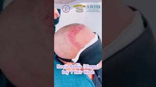 iPlus™️ FUE  Hair Wash after Hair Transplant Naqiu Boboy Singer  Klinik Dr Inder [upl. by Yllehs]