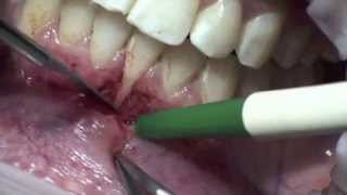 greffe de gencive  greffe gingivale libre [upl. by Eerak]