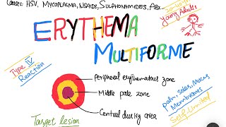 Erythema Multiforme EM causes symptoms treatment  skin disorder [upl. by Eiaj]