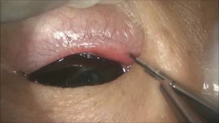 Punch punctoplasty for punctal stenosis by Dr Hunter Yuen [upl. by Namlak]