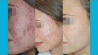 Severe Acne Treatment with Photodynamic Therpy [upl. by Adner882]