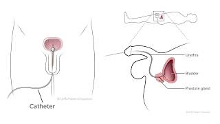 How to Care for Your Catheter Male at Home [upl. by Eirameinna392]