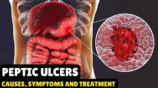 Peptic Ulcers – Causes Signs and Symptoms Diagnosis amp Treatment [upl. by Leachim]