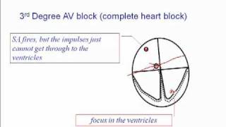 ECG 3rd Degree AV Block [upl. by Ecnarf684]