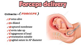 Forceps delivery indications criteria contraindications  medicalmnemonics786 [upl. by Nevarc]