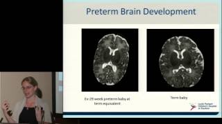 Neurodevelopment of Preterm Babies [upl. by Duaner]