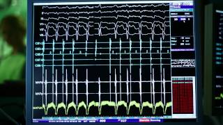 Ablacja arytmii komorowej u chorych bez organicznej choroby serca [upl. by Glenine408]