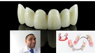 Prótesis Dental Removible o Fija Como son Cual es la diferencia [upl. by Zebulen]