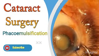 Cataract Surgery Complete With Phacoemulsification [upl. by Aikahs]