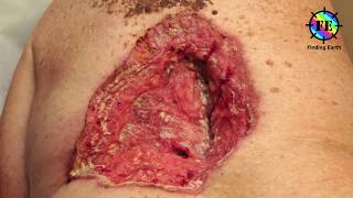 Skin Cancer  Symptom Causes amp Diagnosis Finding Earth [upl. by Linad407]