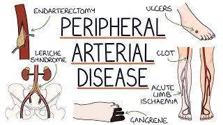 Understanding Peripheral Arterial Disease [upl. by Nehcterg]