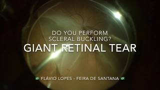 Giant retinal tear  To buckle or not  Author Flávio Lopes MD [upl. by Freddi]