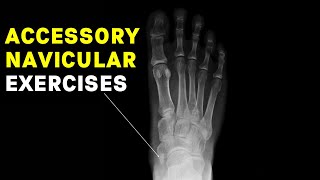 Accessory Navicular Syndrome Exercises by a Foot Specialist [upl. by Ahtikal796]